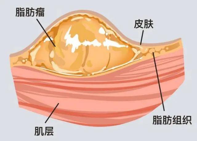 它是一种由成熟脂肪细胞组成的良性肿瘤