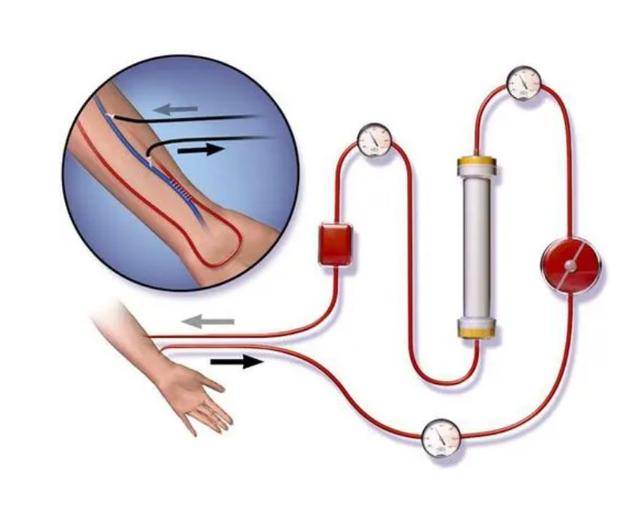 血液透析原理示意图图片