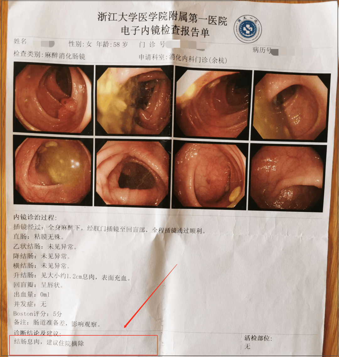 在婆婆不知道的情况下,我们帮她干掉了肠癌