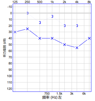 左耳纯音测听-显示左耳传导性听力下降左耳声导抗-b型鼓室图3,电耳镜
