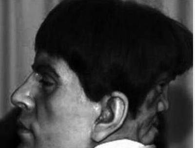 他的后脑长出了第二张脸因无法忍受流言蜚语在23岁自杀身亡