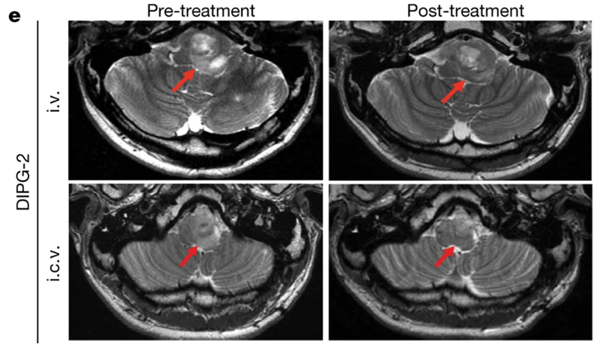 cart疗法后致命的脑癌缩小了两篇重磅文章预示着靶向实体瘤阶段性成功