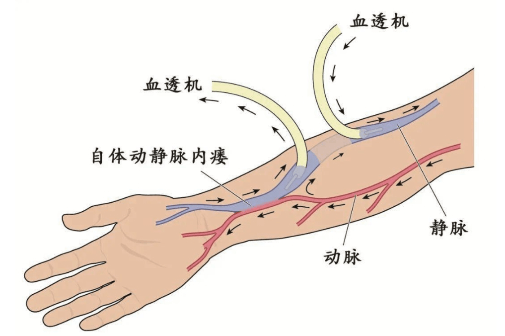 透析瘘管手术步骤图解图片