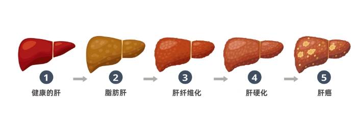 从脂肪肝到肝癌只有4步,如何有效预防?_肝脏_加以控制_发展