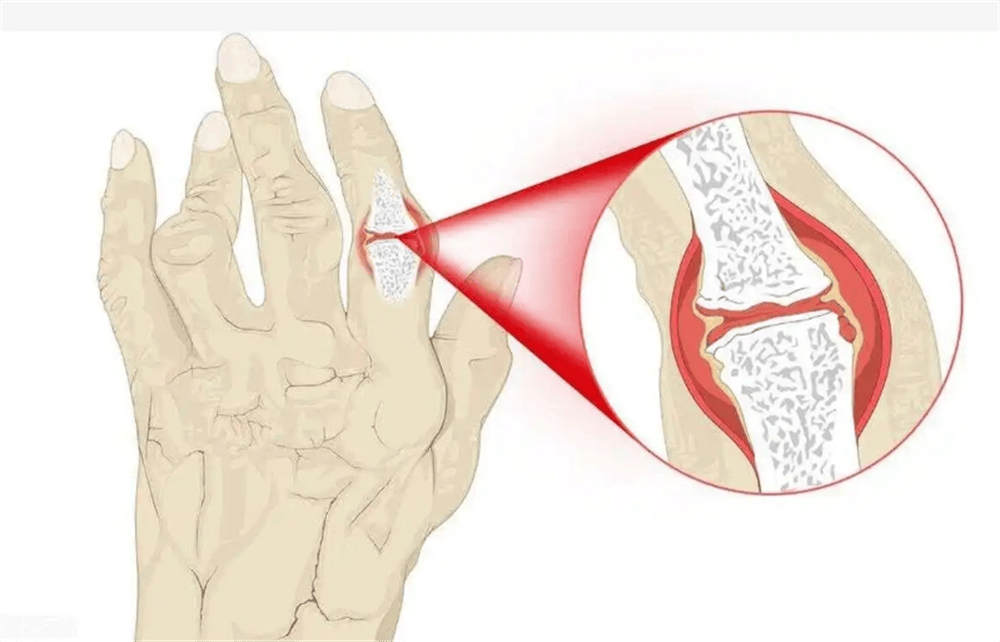 类风湿日常生活注意事项有哪些日常生活护理全攻略让你舒适每一天