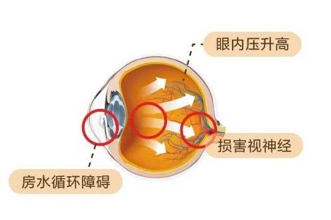 世界青光眼日爱尔眼科提醒青光眼不挑年龄年轻人也需警惕