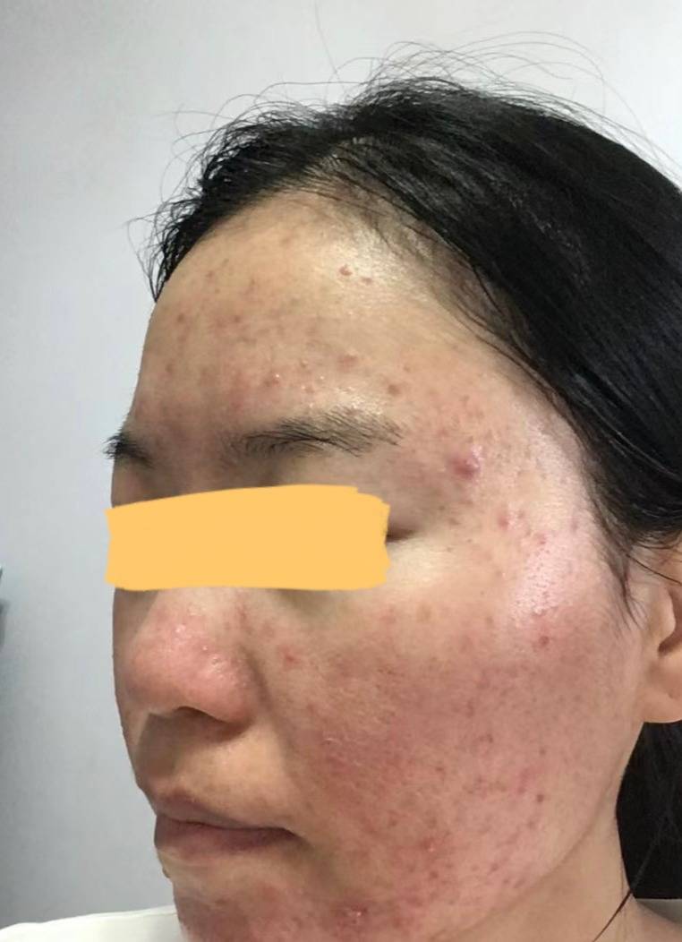 公认3个祛痤疮妙招在家只需花200快就能治好不看吃大亏