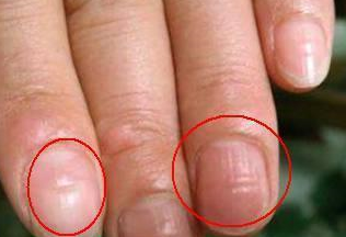 也有的人会出现指甲盖下凹的情况,这都是肝脏不好在指甲上发出的信号