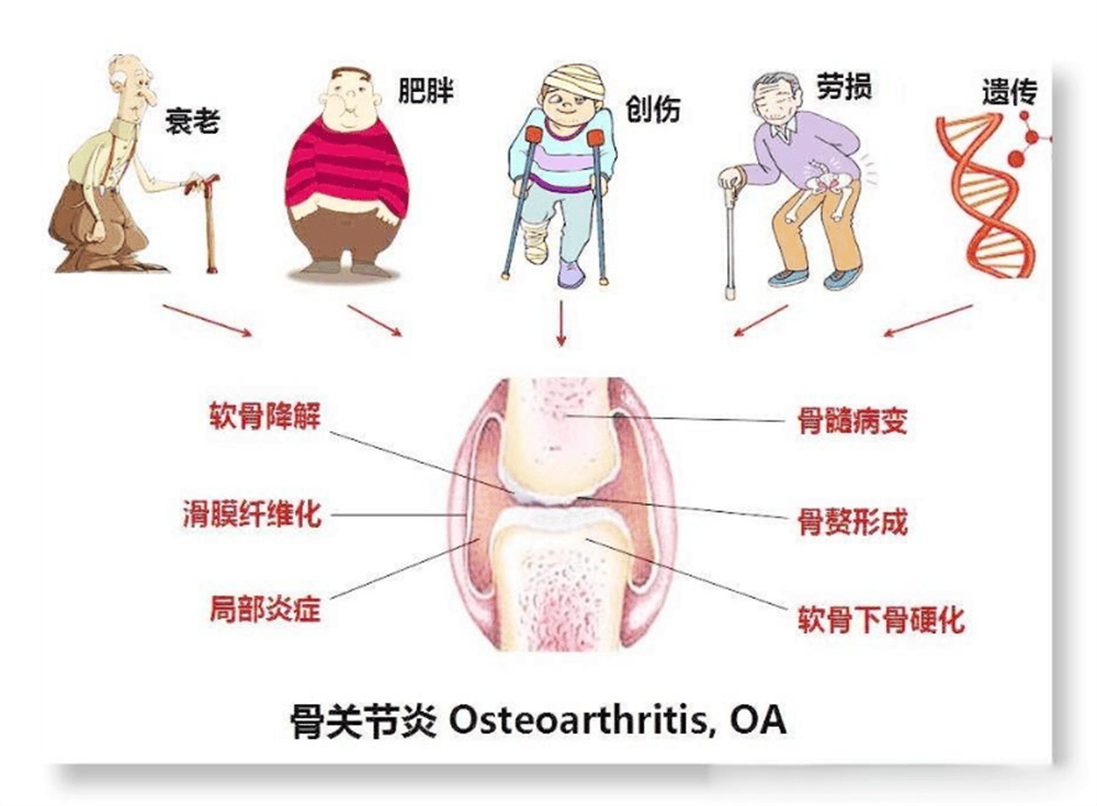 春季骨关节炎疼痛怎么办?告别春季骨痛