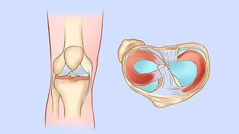 膝盖滑膜炎位置图图片
