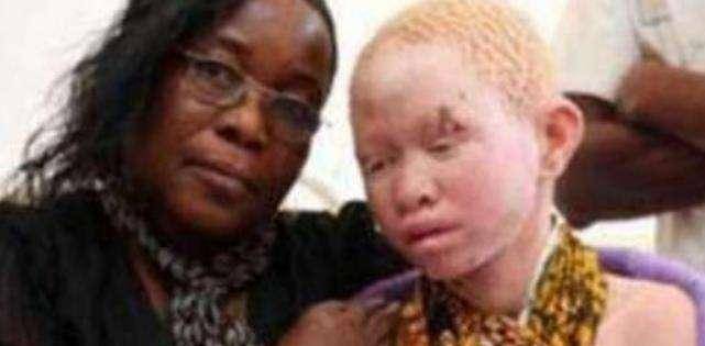 原创非洲人变白后成唐僧肉血液比金子昂贵警察24小时保护