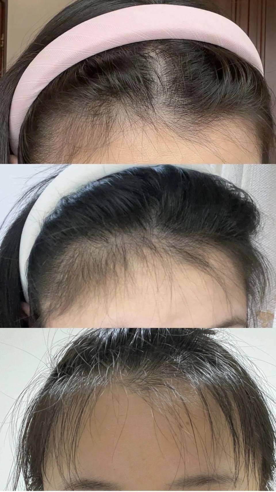 头发_头皮_问题