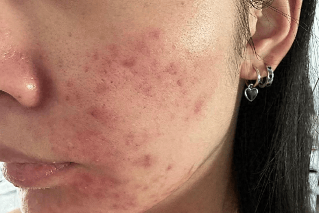 满脸痘痘痘印终于没了过来人分享自用好物用完想不好都难