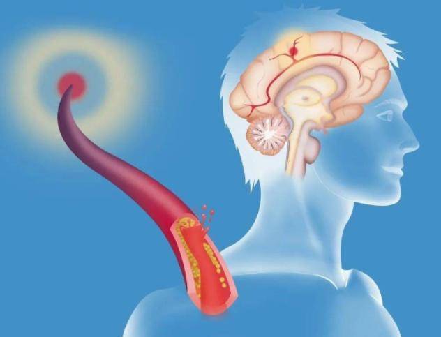 什么是脑梗?脑梗问题控制不佳,会给身体带来哪些危害?_疾病_有关_类型