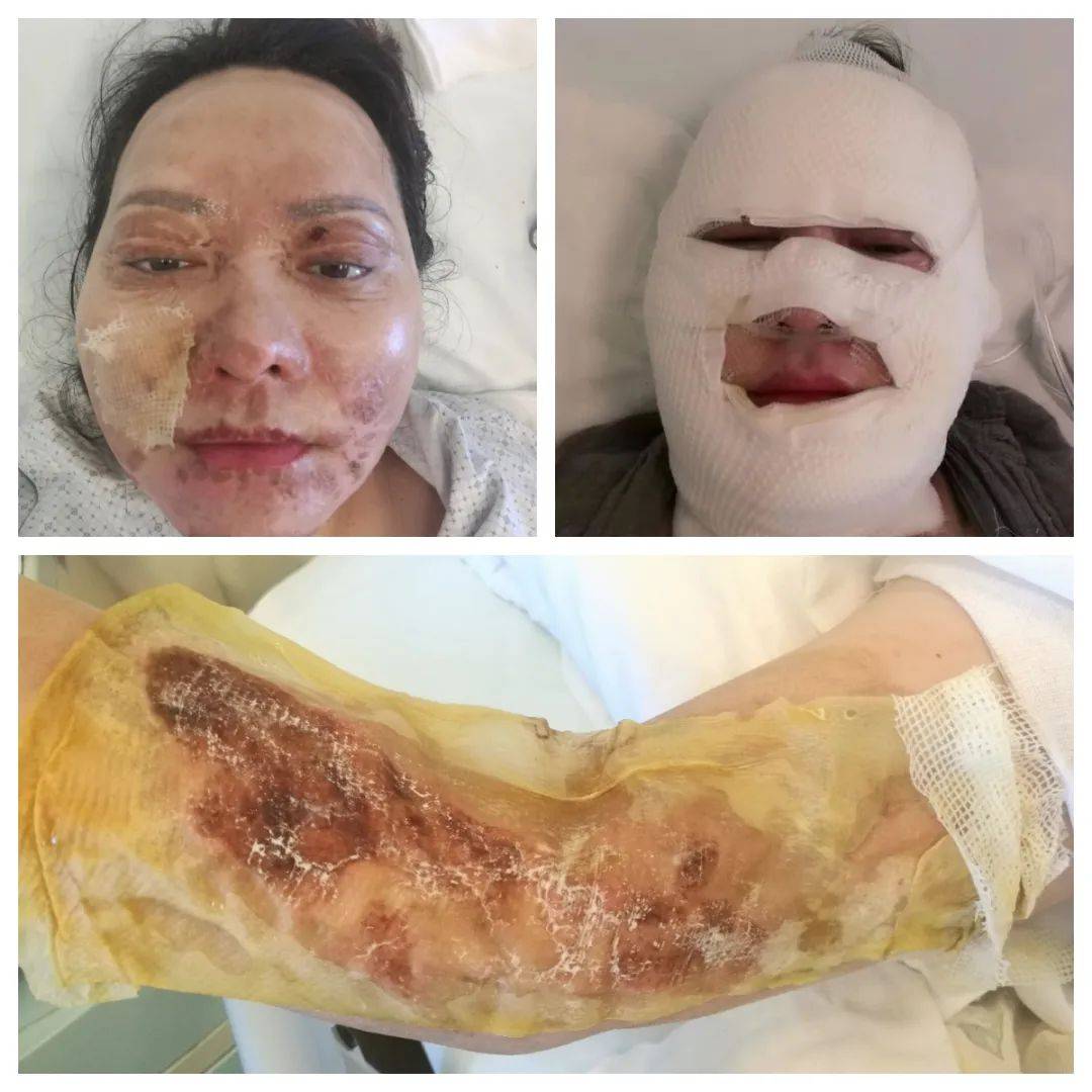 在2018年的一次意外事故,因煤气爆炸造成全身30%三度烧伤,这场突如其
