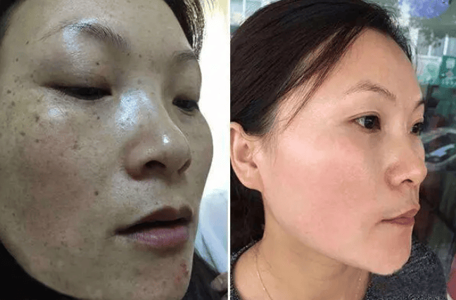 淡斑祛斑效果排名第一,哪个牌子最好用?_肌肤_黑色素_皮肤