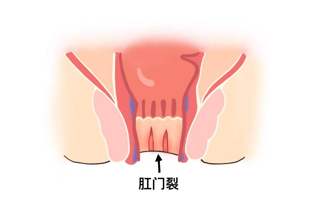 肛裂: 肛裂是由于肛门口的裂口引起的,在排便时可能会出现便血,伴随着