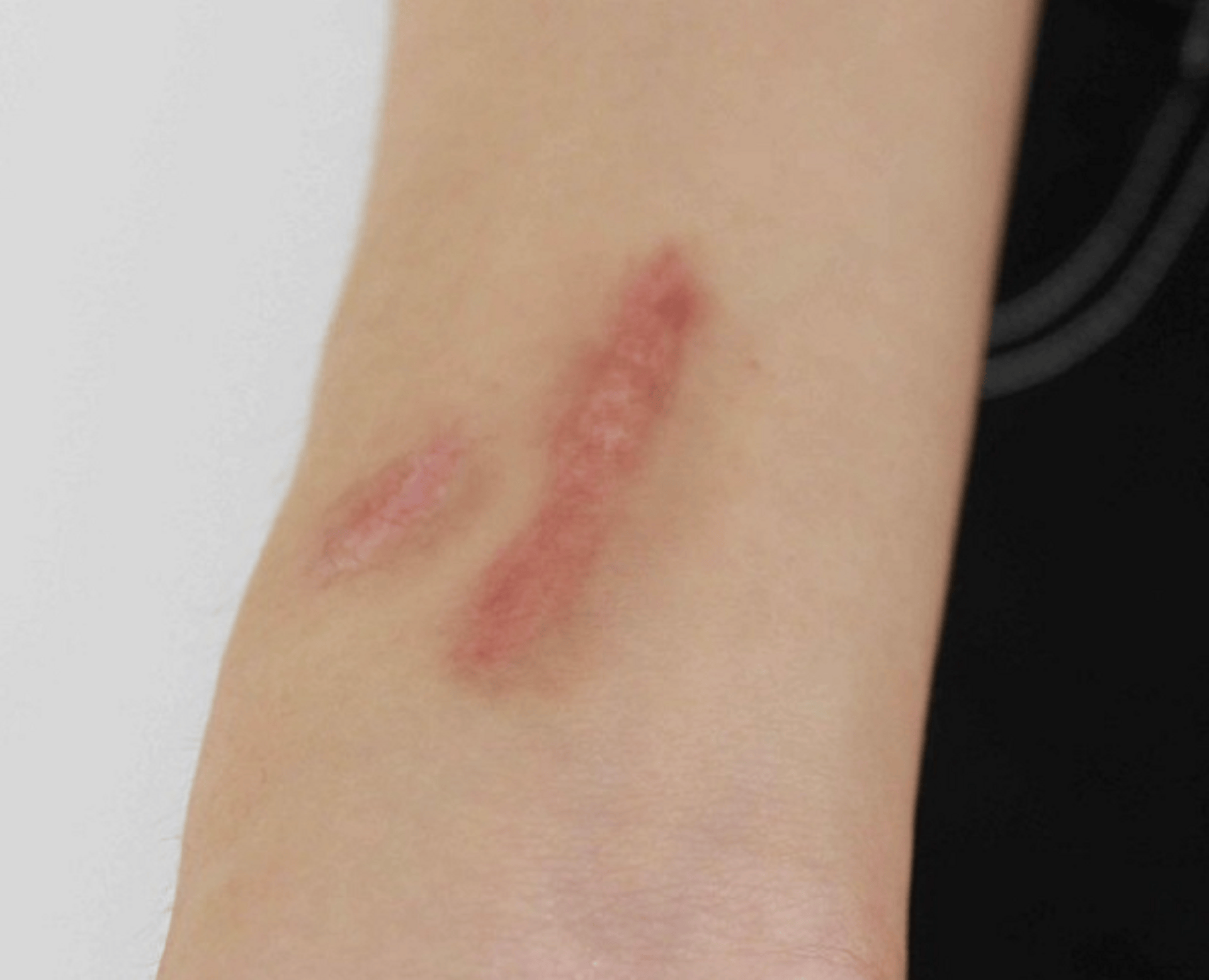 烫伤灼烧发痒难耐芦荟胶它就能轻松解决用过的都说好