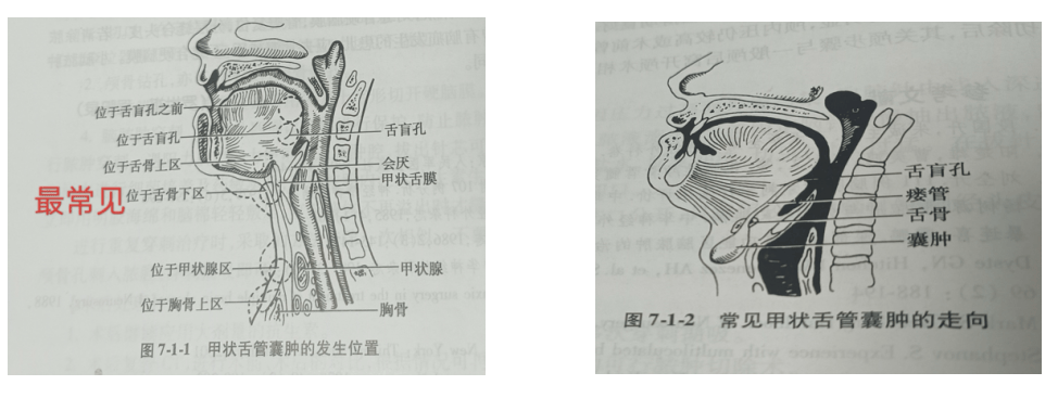 【科普】孩子长出喉结?可能是甲状舌管囊肿