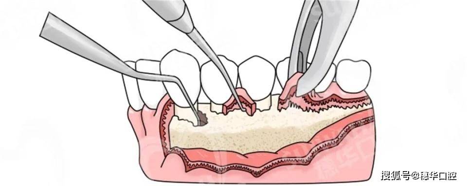 牙周炎主要由牙周袋或龈袋内的细菌直接或间接作用引起的牙周组织损伤