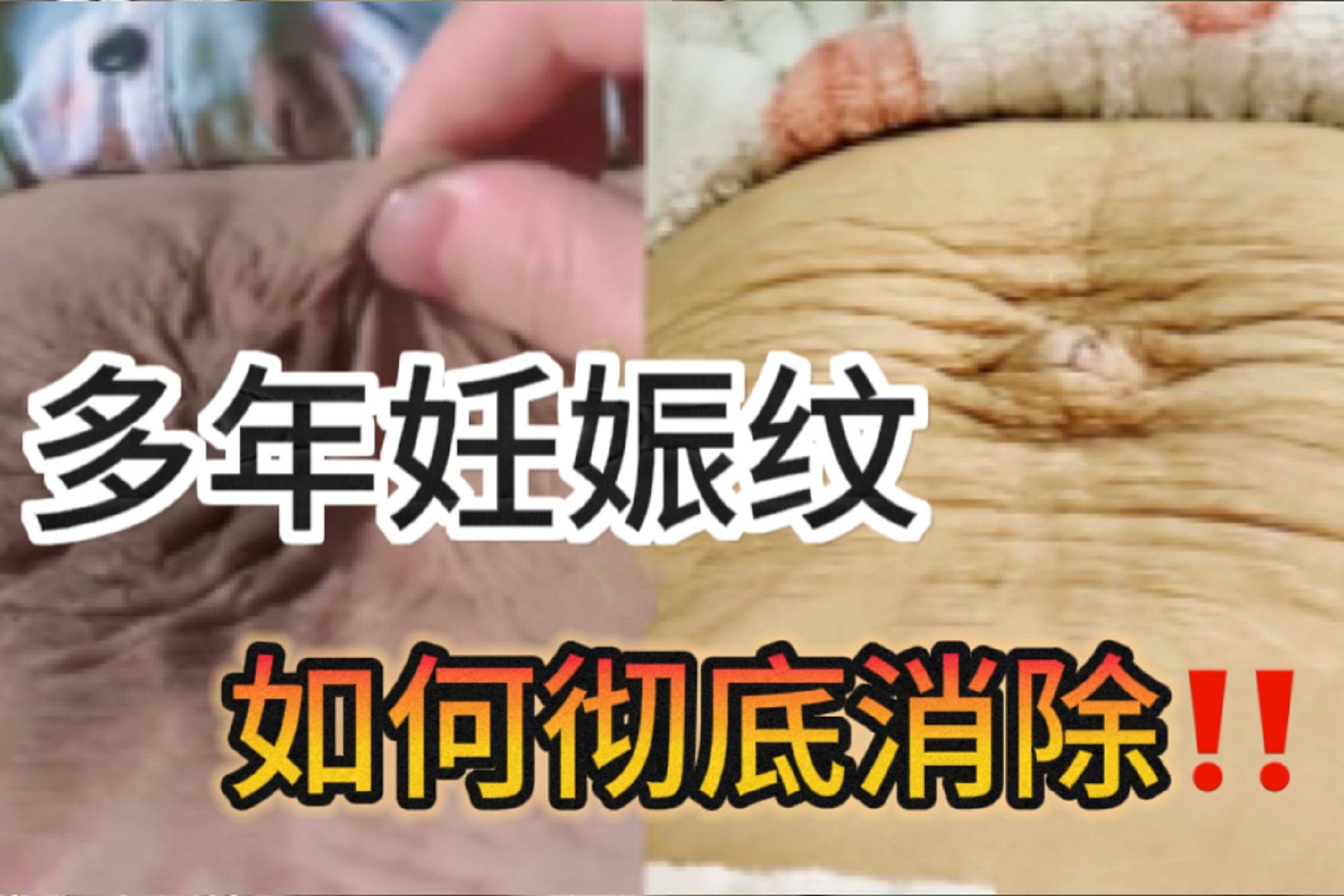 多年白色妊娠纹还有救3个淡纹产品任用1个纹路自己淡化消失