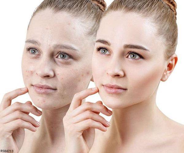 原创鸡皮肤让人自卑一文带你了解它的形成原因or该如何改善