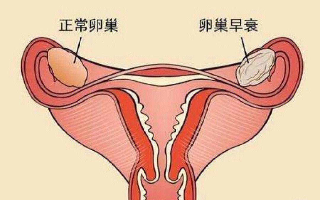 双侧多囊卵巢图片图片