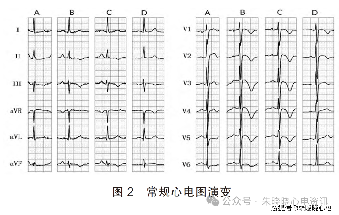 正常三导联心电图图片