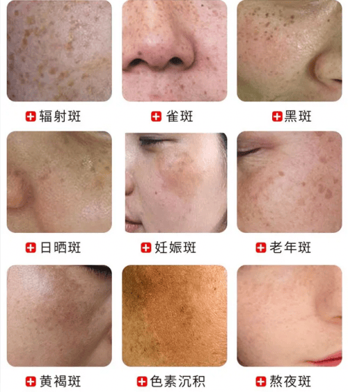 祛斑产品哪个效果好这几款优势突出
