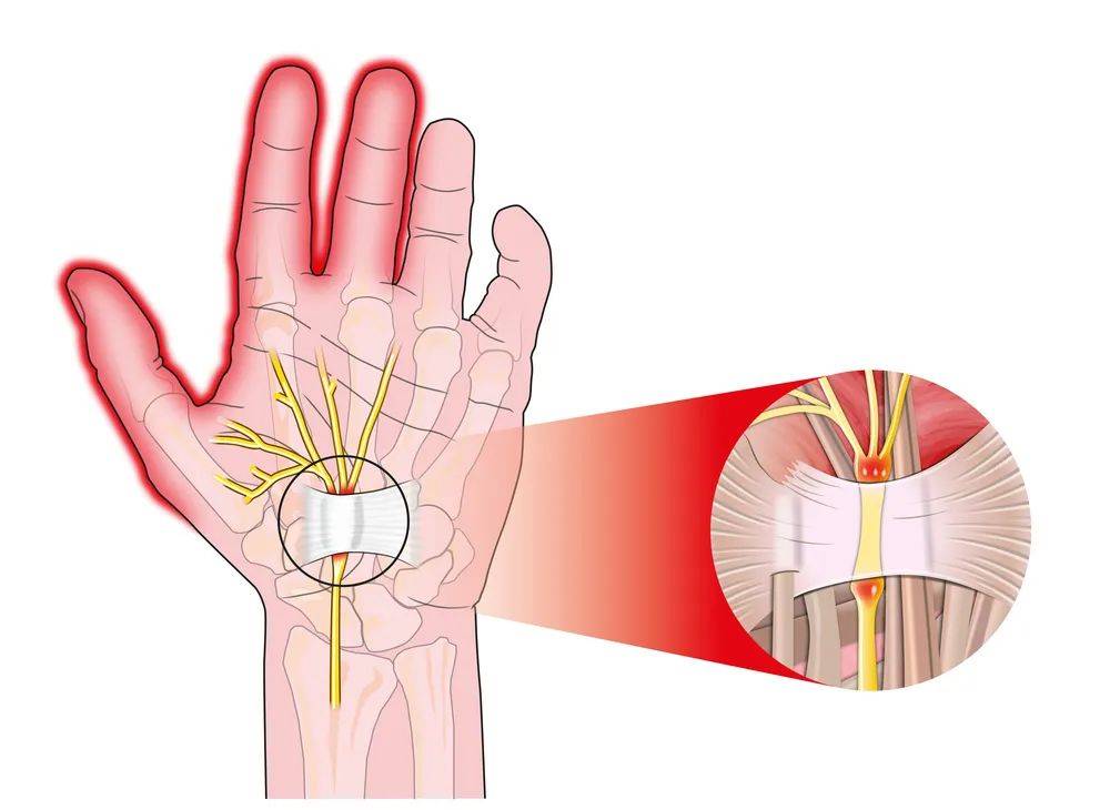 鼠标手,在临床上称腕管综合症,指腕管内正中神经受卡压导致的一组