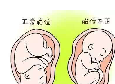孕妈身体出现这4种异常情况,请不要选择顺产:1,临产前,胎位不正妊娠