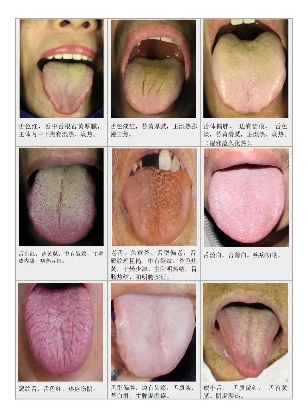 舌苔的厚薄,润燥,颜色等都能反映出人体内部的病理变化
