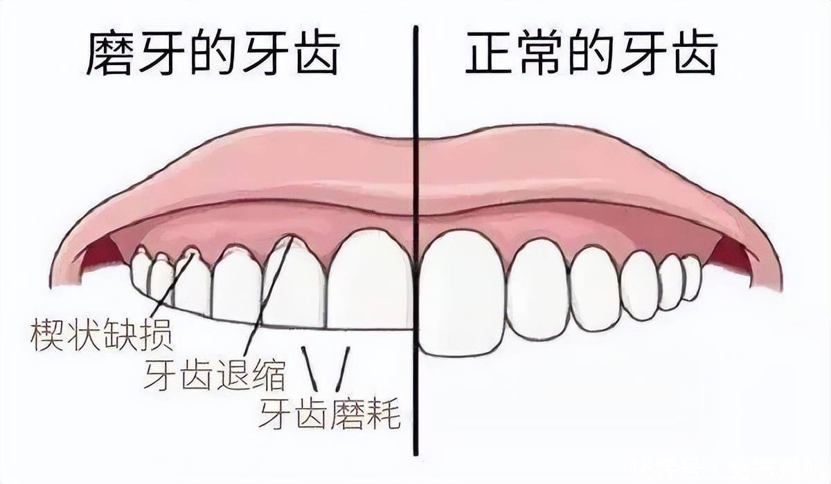 磨牙是一个很典型的坏习惯,长期磨牙会加重对牙釉质的磨损,牙釉质随着