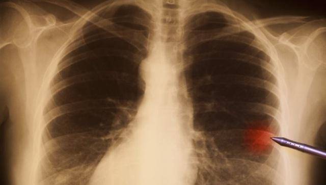 多数情况下不用治_肺部_病变_小结