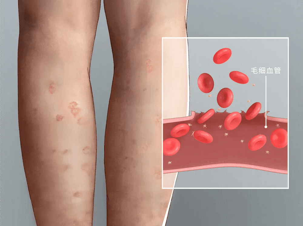 过敏性紫癜不容易对付治疗过程中需要慎之又慎