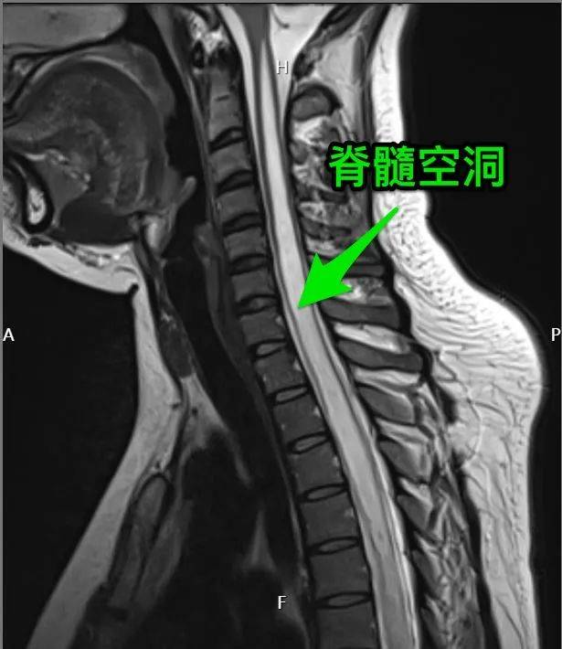 脊髓空洞病图片