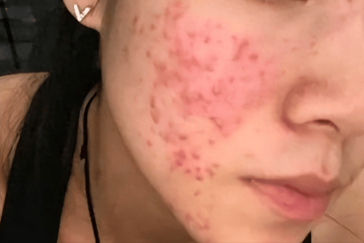 对抗青春痘及痘印的方法合集随便掌握一个轻松拥有好皮肤