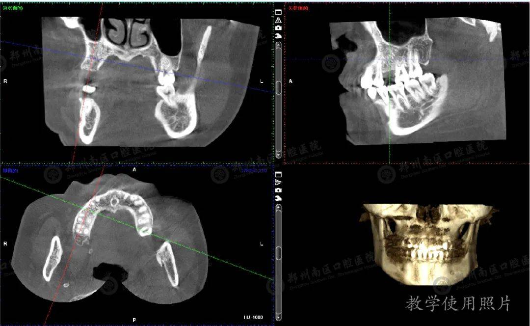 婴儿牙齿图CT图片