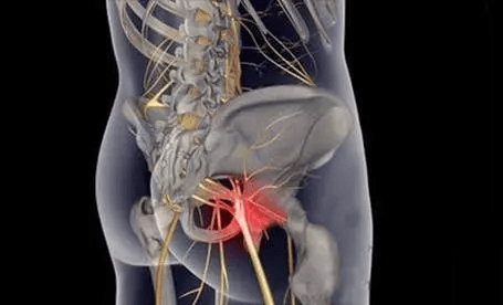 坐骨神经疼最佳治愈方法来袭 专业人士联合转发