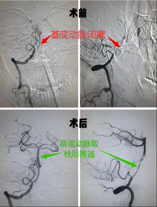 介入治疗解烦脑