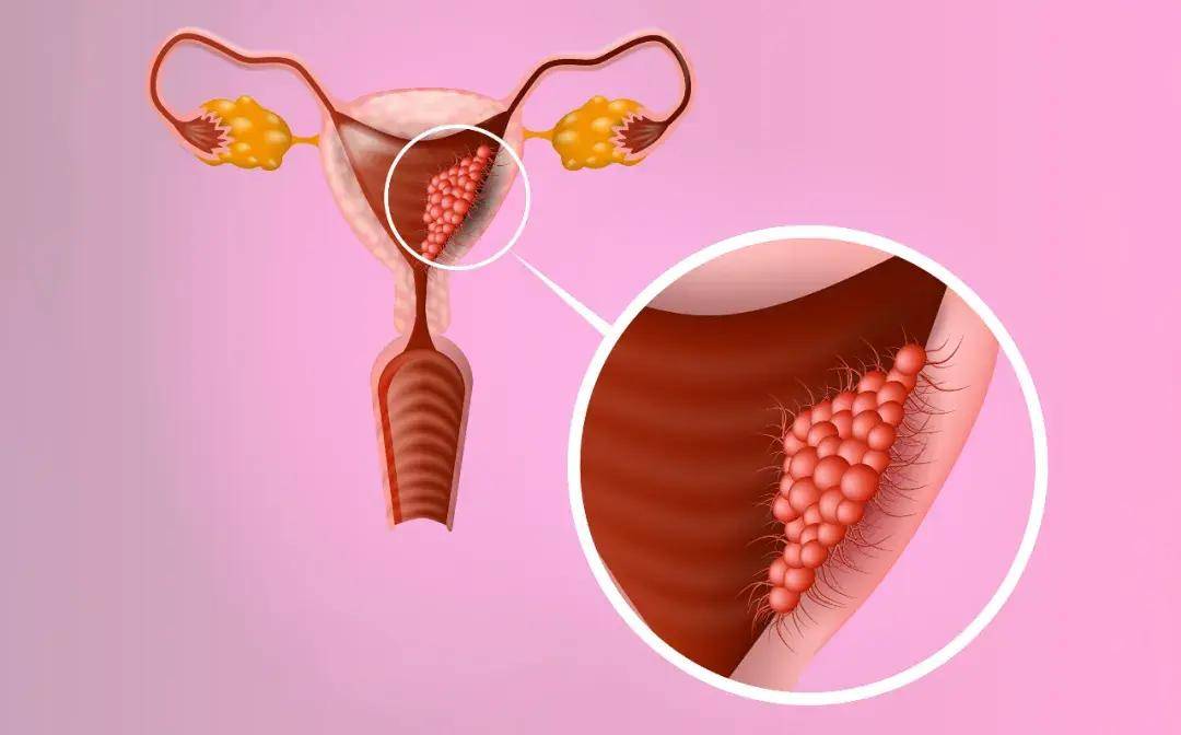 女性长期腰酸,腰痛,警惕这5种妇科病!(附自查方法)_子宫_原因_盆腔