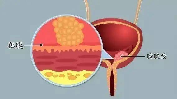 膀胱癌是怎么引起的图片