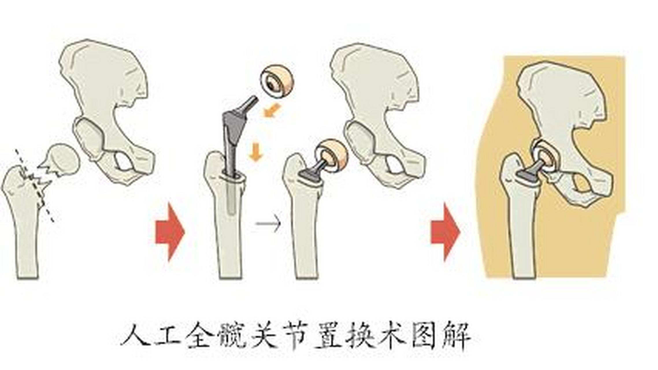 刘欢讲人工髋关节置换图片