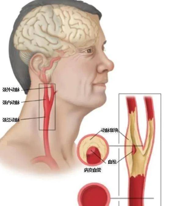 颈动脉出现了斑块,对身体哪个部位影响最大?需注意什么呢?