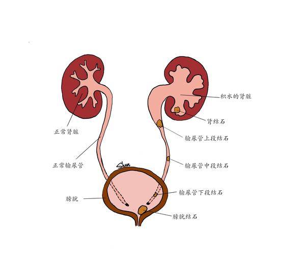 女性尿结石症状图片