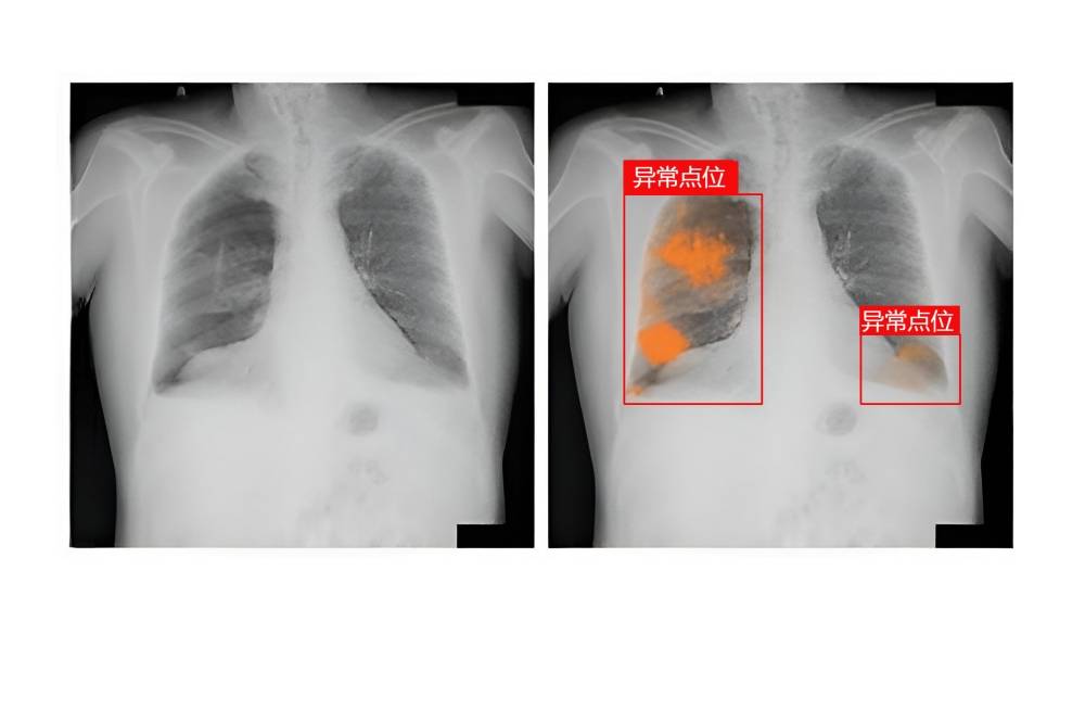 医学影像分析医学影像分析胸片异常点位ai识别技术在医疗业方面有着