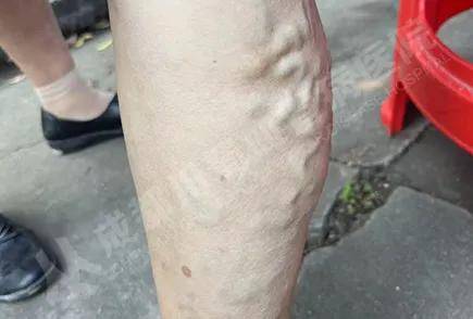 静脉曲张的"警告信号"你知道吗?99%的人都忽视了..._症状_皮肤_血管