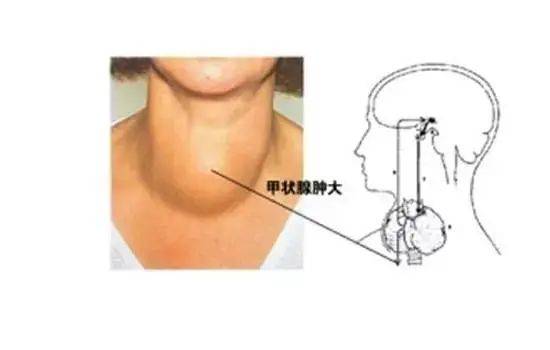 甲状腺位置图片