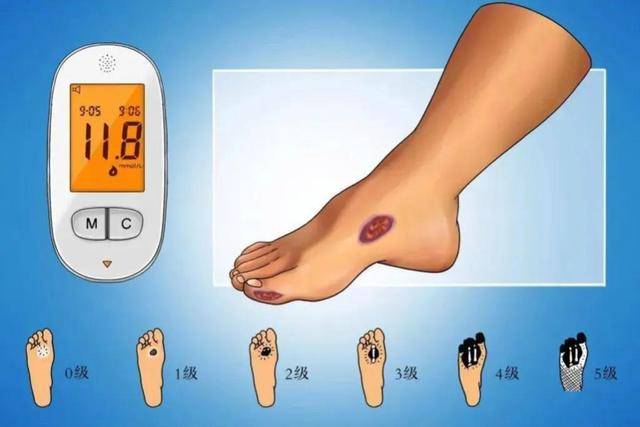 医生:若没有4种迹象,血糖还平稳_胰岛素_症状_水平