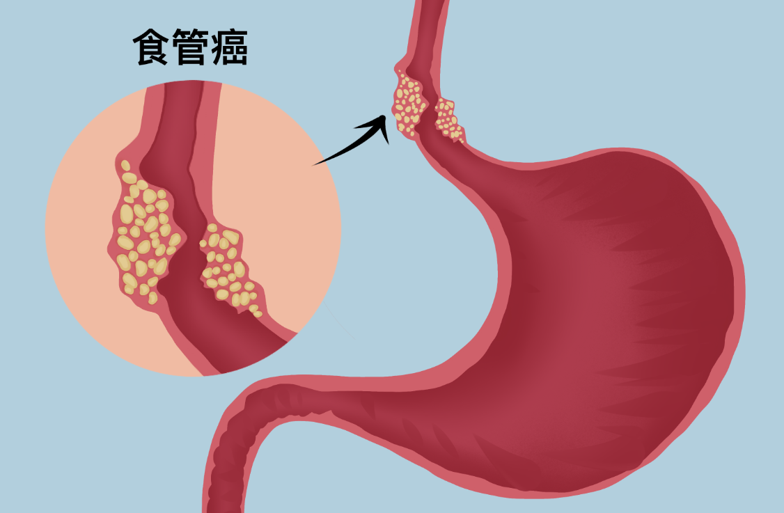 哪些饮食坏习惯容易诱发食道癌?